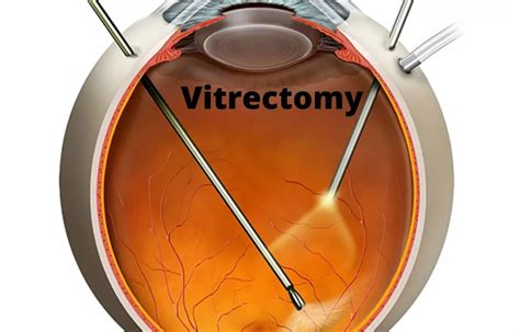 Pars plana vitrectomy improves retinal reattachment but not visual ...