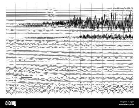 Vector Illustration of ictal EEG recording during seizure. Seizure ...