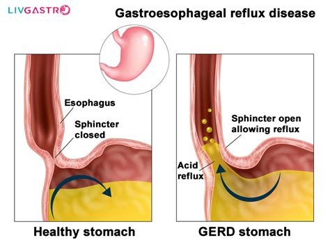 Gastroesophageal Reflux Disease: Causes, Risk Factors, Symptoms ...