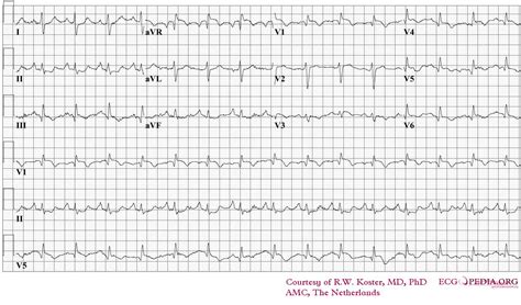 Pulmonary Embolism ECG Changes