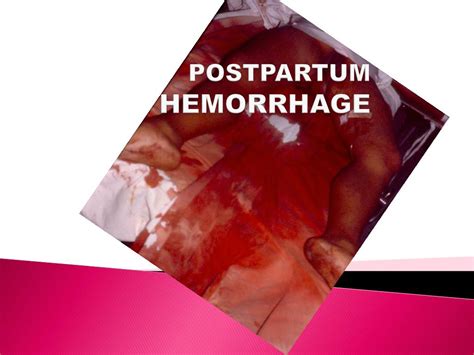 PPT - POSTPARTUM HEMORRHAGE PowerPoint Presentation, free download - ID ...