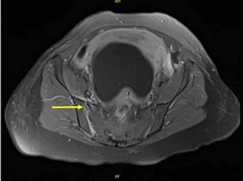 Suspected Septic Sacroiliitis Following Recent Cesarean Section Under ...