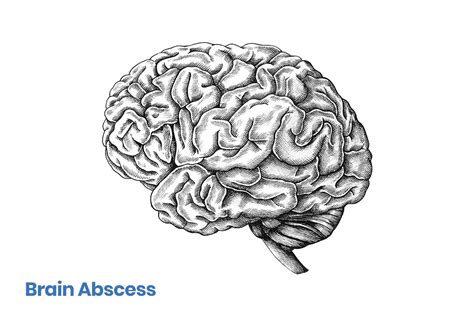 Brain abscess – symptoms, causes, diagnosis and treatment | Hyperbaric ...