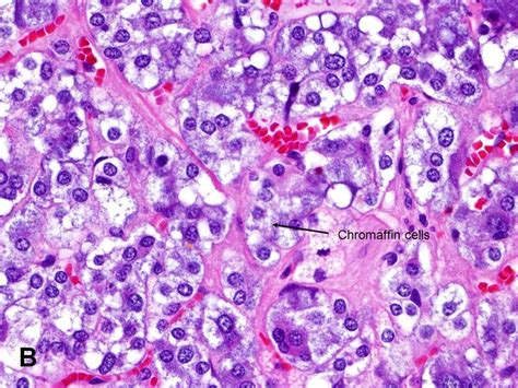 American Urological Association - Adrenal Gland: Medulla