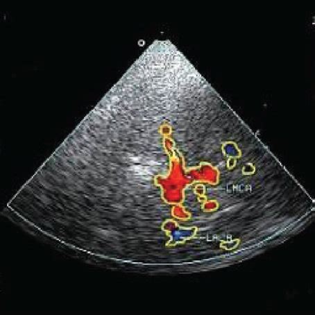 The transcranial color Doppler ultrasound results of the two groups of ...