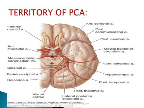 Posterior circulation stroke