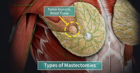 Types of Mastectomy | Complete Anatomy