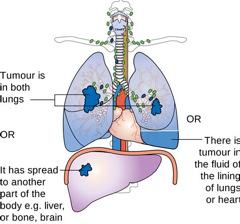 lung cancer - what is cancer - prostate cancer - pancreatic cancer ...