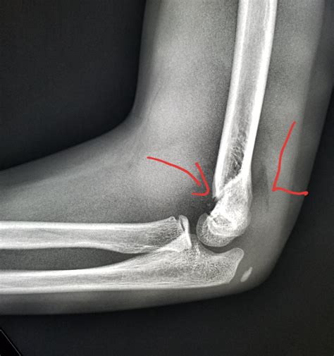 Normal Elbow X Ray In Children