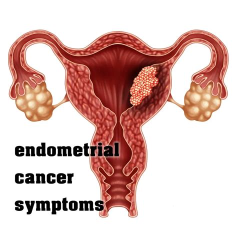 Endometrial Cancer Symptoms | risk factors, stages, treatment