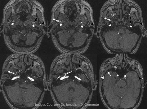 Middle Meningeal Artery | neuroangio.org