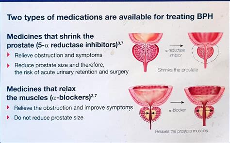 How To Reduce Size Of Prostate - Economicsprogress5