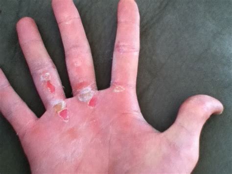 Handling Calluses & Torn Skin When Training – Straight Talking Fitness