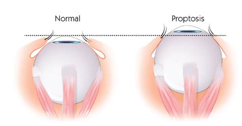 Proptosis / Exophthalmos - Nurses Revision