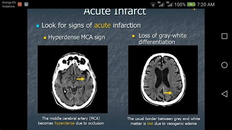 Acute infarction 8 | Radiology imaging, Ct scan, Arteries