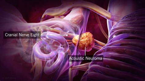 Acoustic Neuroma (Vestibular Schwannoma): Diagnosis, Treatment