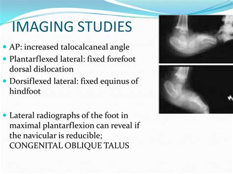 Congenital vertical talus UG lecture | PPT