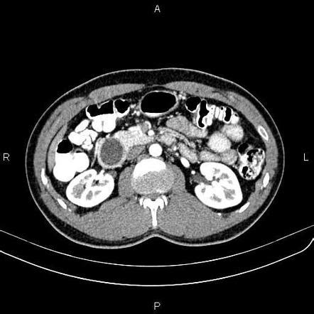 Enteric duplication cyst | Radiology Reference Article | Radiopaedia.org