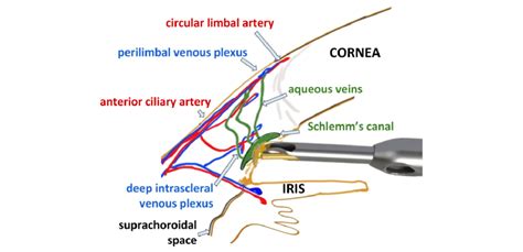 Trabectome tip inserted in Schlemm's canal. Vulnerable structures in ...