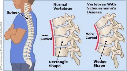 Scheuermann's Kyphosis (for Parents) | Nemours KidsHealth