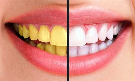 TEETH WHITENING : How to Prevent Yellow Teeth (Without Whitening ...