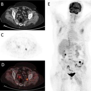 A 71-year-old male patient with mucinous adenocarcinoma in the ...