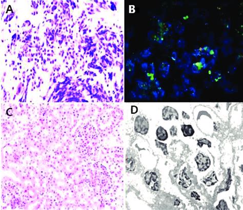 Neuroblastoma Abdominal