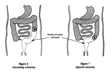 Transverse Colostomy