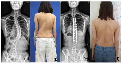 Scoliosis Surgery Before And After