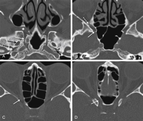 The Sphenoid Bone | Radiology Key