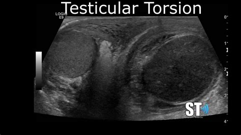 Testicular/Scrotal Doppler Protocol – Sonographic Tendencies