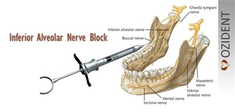 Inferior Alveolar Nerve Block Landmarks