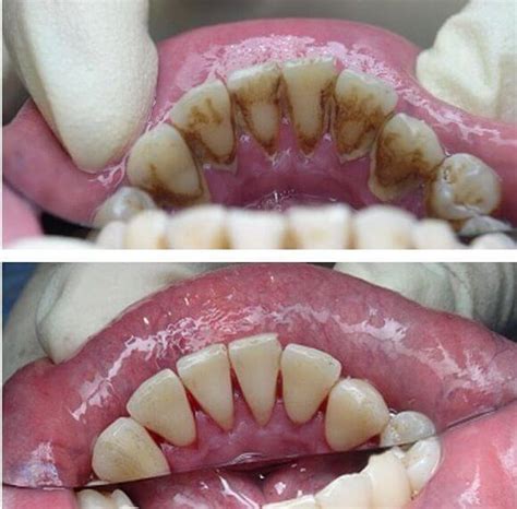 Teeth Cleaning Before and After - Teeth FAQ Blog