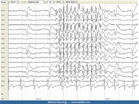 EEG in epilepsy | MedLink Neurology