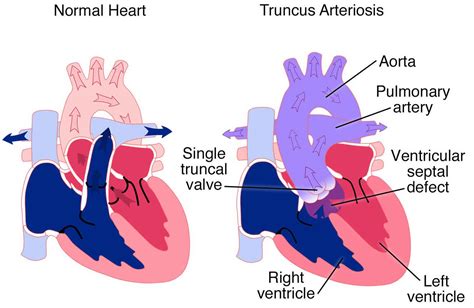 Truncus arteriosus causes, symptoms, diagnosis, treatment & prognosis