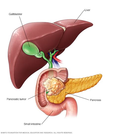 Cáncer de páncreas - Síntomas y causas - Mayo Clinic