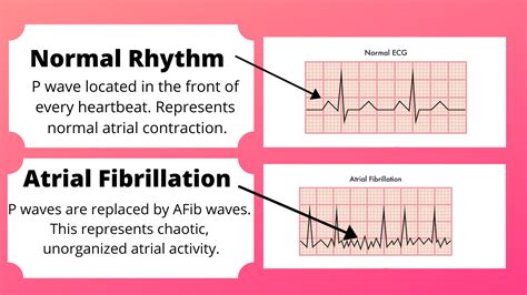 What Does Afib Ecg Look Like - Printable Templates Protal