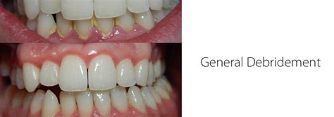 General Debridement - Kians Dental Studio