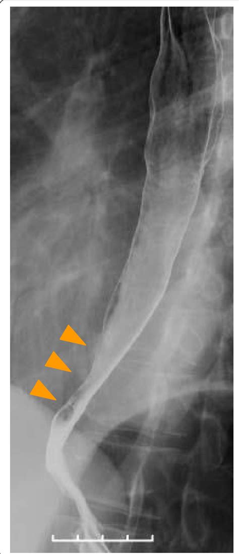 Esophagography revealed the smooth stenosis at the lower esophagus ...