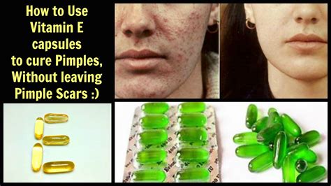 Aloe Vera And Vitamin E For Acne Scars