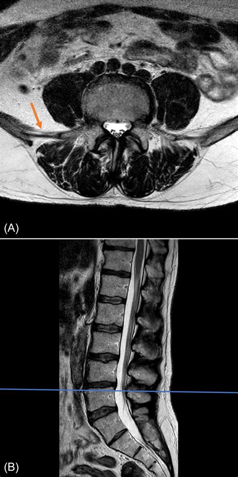 Lumbar Spine Mri Axial