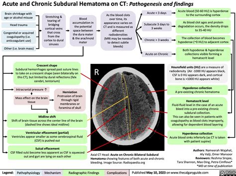 Chronic Subdural Hematoma Vs Acute