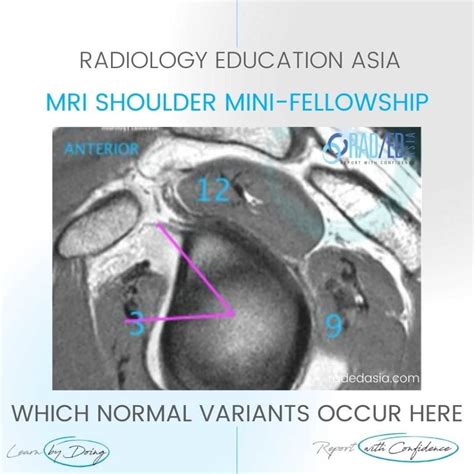 Mri Shoulder Labrum Tear