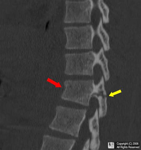 Learning Radiology - Chance Fracture