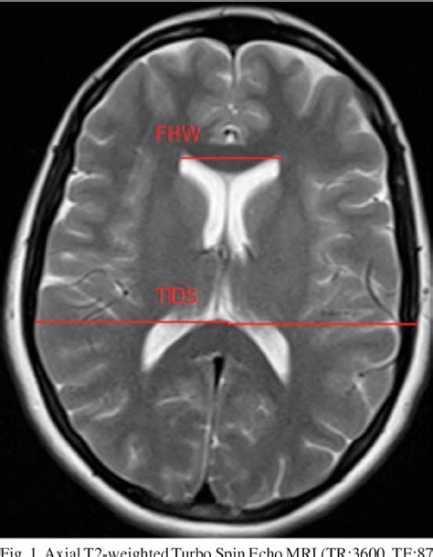 Figure 1 from Morphometric MRI Study of the Brain Ventricles in Healthy ...