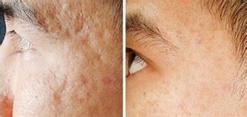 Dermaroller Before And After Picture Acne Scars