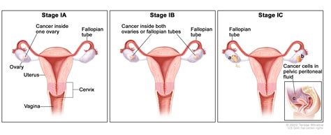 Ovarian Epithelial, Fallopian Tube, and Primary Peritoneal Cancer ...