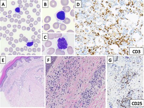 Microscopic images. Peripheral blood smears demonstrated scattered ...