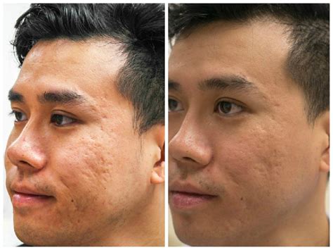 How PRP Injection Solves Facial Acne Scar In Selangor & KL | Malaysia ...