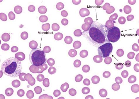 Monoblast : - More cytoplasm - Nucleus has finely dispersed chromatin ...